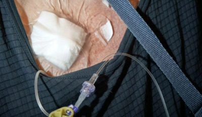 bard-powerport-catheter-400×232 bard-powerport-catheter